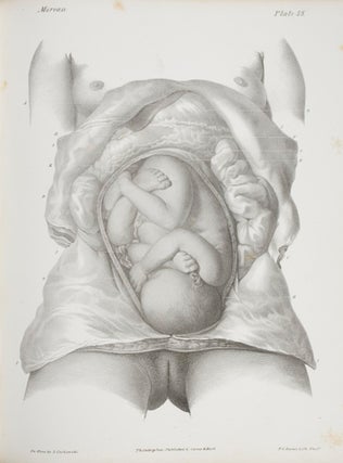 A Practical Treatise on Midwifery: Exhibiting the Present Advanced State of the Science