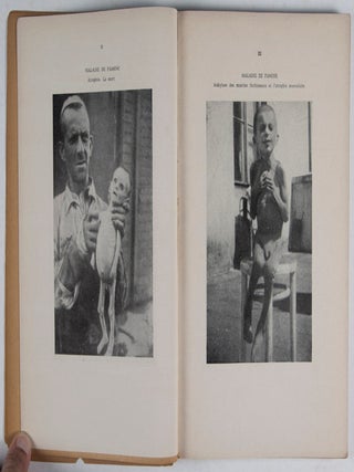 Maladie de Famine: Recherches Cliniques sur la Famine Exécutée dans le Ghetto de Varsovie en 1942