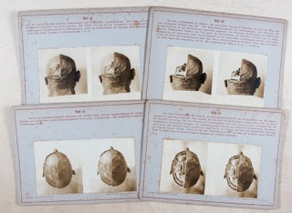 Stereoskopische Bilder zur Gehirn-Schädel-Topographie (Stereoscopic Images for Brain-Skull-Topography)