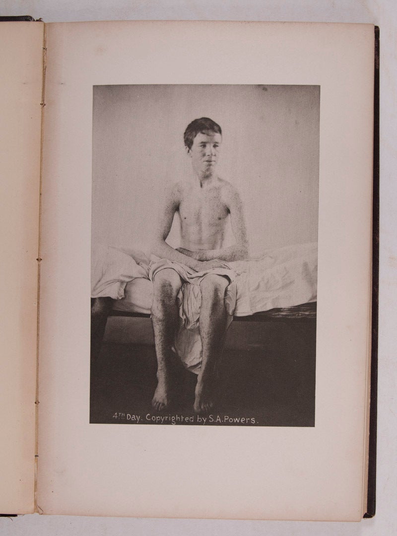 Heliotype Examples Variola. Smallpox A Series of Twenty-One Heliotype Plates Illustrating ...